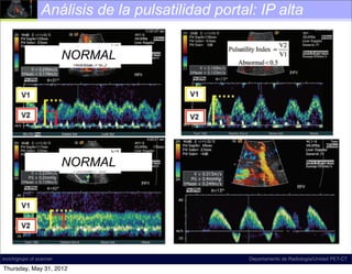 Análisis de la pulsatilidad portal: IP alta
                               180 January-February 2011




                       NORMAL                                      Spectral Doppler US image shows
                                                     tile waveform with ﬂow reversal in the right por
                                                     The waveform may be systematically characte
                                                     predominantly antegrade, pulsatile, biphasic-b
                                                     tional, and di-inﬂectional.


0     January-February 2011                                                      radiographics.rsna.org




                       NORMAL




     Figure 24. Normal and abnormal portal            FigureSpectralSlow portalimage shows a pulsa-
                                                              26. Doppler US venous ﬂow. Spectra
incich/grupo ct scanner                         tile waveform with ﬂow reversal in the right portal vein.
                                                                         Departamento de Radiología/Unidad PET-CT
     venous phasicity. Images show a spectrum         pler US image shows slow ﬂow in the main po
    Thursday, May 31, 2012                      The waveform may be systematically characterized as
 