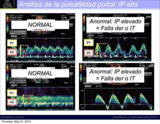 Análisis de la pulsatilidad portal: IP alta
                               180 January-February 2011



                                                         Anormal: IP Doppler US image shows
                                                                           elevado
                       NORMAL                                     Spectral
                                                     tile waveform with derreversal in the right por
                                                            = Falla ﬂow o IT
                                                     The waveform may be systematically characte
                                                     predominantly antegrade, pulsatile, biphasic-b
                                                     tional, and di-inﬂectional.


0     January-February 2011                                                      radiographics.rsna.org




                       NORMAL                           Anormal: IP elevado
                                                          = Falla der o IT




     Figure 24. Normal and abnormal portal            FigureSpectralSlow portalimage shows a pulsa-
                                                              26. Doppler US venous ﬂow. Spectra
incich/grupo ct scanner                         tile waveform with ﬂow reversal in the right portal vein.
                                                                         Departamento de Radiología/Unidad PET-CT
     venous phasicity. Images show a spectrum         pler US image shows slow ﬂow in the main po
    Thursday, May 31, 2012                      The waveform may be systematically characterized as
 