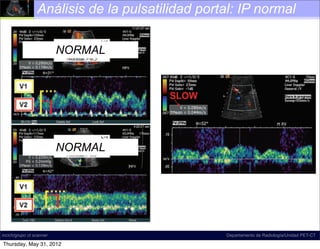 Análisis de la pulsatilidad portal: IP normal
                                                                         Spectral Doppler US image shows a pulsa-
                                                           tile waveform with ﬂow reversal in the right portal vein.
                                                           The waveform may be systematically characterized as
                    NORMAL                                 predominantly antegrade, pulsatile, biphasic-bidirec-
                                                                              Spectral Doppler US image shows
                                                           tional, and di-inﬂectional.ﬂow reversal in the right por
                                                                tile waveform with
                                                              The waveform may be systematically characte
                                                              predominantly antegrade, pulsatile, biphasic-b
                                                              tional, and di-inﬂectional.




                    NORMAL

           Figure 24. Normal and abnormal portal           Figure 26. Slow portal venous ﬂow. Spectral Dop-
           venous phasicity. Images show a spectrum        pler US image shows slow ﬂow in the main portal vein.
           of increasing pulsatility (bottom to top).      Slow portal venous ﬂow is a consequence of portal hy-
           Note that increasing pulsatility corresponds    pertension. In this case, the peak velocity is 9.0 cm/sec,
           to a decrease in the calculated PI. Although    which is well below the lower limit of normal (16–40
           normal phasicity ranges widely in the portal    cm/sec). Although portal hypertension may cause a
                                                           pulsatile-appearing waveform as venousthis case, the
                                                              Figure 26. Slow portal seen in ﬂow. Spectra
     Figure 24. PI should and abnormal 0.5
           veins, the Normal be greater than portal
incich/grupo ct scanner and bottom). When the PI is less
           (middle                                         slow ﬂow helps differentiate this condition from hyper-
                                                                                     Departamento de Radiología/Unidad PET-CT
     venous phasicity.the waveform may spectrum
                              Images show a be called         pler US image shows such as CHF and tricuspidpo
                                                           pulsatile high-velocity states
                                                                                           slow ﬂow in the main
 Thursday, May 31, (top),
           than 0.5 2012
 
