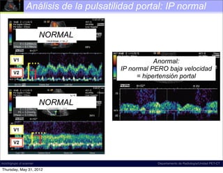 Análisis de la pulsatilidad portal: IP normal
                                                                         Spectral Doppler US image shows a pulsa-
                                                           tile waveform with ﬂow reversal in the right portal vein.
                                                           The waveform may be systematically characterized as
                    NORMAL                                 predominantly antegrade, pulsatile, biphasic-bidirec-
                                                                              Spectral Doppler US image shows
                                                           tional, and di-inﬂectional.ﬂow reversal in the right por
                                                                tile waveform with
                                                              The waveform may be systematically characte
                                                              predominantly antegrade, pulsatile, biphasic-b
                                                              tional, and di-inﬂectional.
                                                                               Anormal:
                                                               IP normal PERO baja velocidad
                                                                     = hipertensión portal



                    NORMAL

           Figure 24. Normal and abnormal portal           Figure 26. Slow portal venous ﬂow. Spectral Dop-
           venous phasicity. Images show a spectrum        pler US image shows slow ﬂow in the main portal vein.
           of increasing pulsatility (bottom to top).      Slow portal venous ﬂow is a consequence of portal hy-
           Note that increasing pulsatility corresponds    pertension. In this case, the peak velocity is 9.0 cm/sec,
           to a decrease in the calculated PI. Although    which is well below the lower limit of normal (16–40
           normal phasicity ranges widely in the portal    cm/sec). Although portal hypertension may cause a
                                                           pulsatile-appearing waveform as venousthis case, the
                                                              Figure 26. Slow portal seen in ﬂow. Spectra
     Figure 24. PI should and abnormal 0.5
           veins, the Normal be greater than portal
incich/grupo ct scanner and bottom). When the PI is less
           (middle                                         slow ﬂow helps differentiate this condition from hyper-
                                                                                     Departamento de Radiología/Unidad PET-CT
     venous phasicity.the waveform may spectrum
                              Images show a be called         pler US image shows such as CHF and tricuspidpo
                                                           pulsatile high-velocity states
                                                                                           slow ﬂow in the main
 Thursday, May 31, (top),
           than 0.5 2012
 