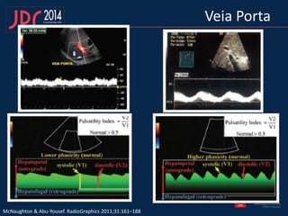 McNaughton & Abu-Yousef. RadioGraphics 2011;31:161–188
Veia Porta
 