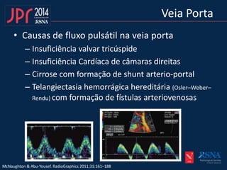 • Causas de fluxo pulsátil na veia porta
– Insuficiência valvar tricúspide
– Insuficiência Cardíaca de câmaras direitas
– Cirrose com formação de shunt arterio-portal
– Telangiectasia hemorrágica hereditária (Osler–Weber–
Rendu) com formação de fístulas arteriovenosas
Veia Porta
McNaughton & Abu-Yousef. RadioGraphics 2011;31:161–188
 