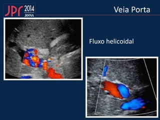 Veia Porta
Fluxo helicoidal
 