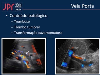 Veia Porta
• Conteúdo patológico
– Trombose
– Trombo tumoral
– Transformação cavernomatosa
 