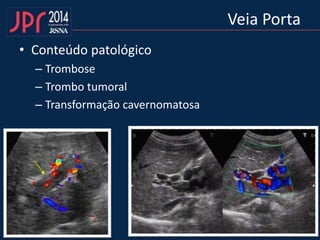 Veia Porta
• Conteúdo patológico
– Trombose
– Trombo tumoral
– Transformação cavernomatosa
 