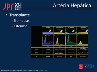 Artéria Hepática
• Transplante
– Trombose
– Estenose
McNaughton & Abu-Yousef. RadioGraphics 2011;31:161–188
 