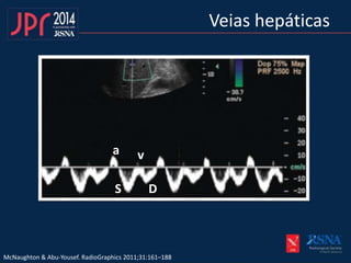 Veias hepáticas
McNaughton & Abu-Yousef. RadioGraphics 2011;31:161–188
DS
va
 