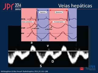 Veias hepáticas
D
S
v
McNaughton & Abu-Yousef. RadioGraphics 2011;31:161–188
a
 