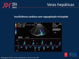 Veias hepáticas
Insuficiência cardíaca sem regurgitação tricúspide
McNaughton & Abu-Yousef. RadioGraphics 2011;31:161–188
 
