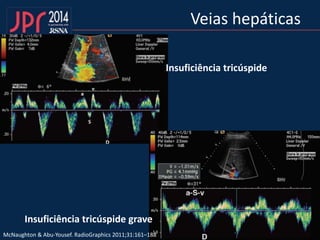 Veias hepáticas
Insuficiência tricúspide grave
Insuficiência tricúspide
McNaughton & Abu-Yousef. RadioGraphics 2011;31:161–188
 