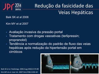 Redução da fasicidade das
Veias Hepáticas
Baik SK et al 2006
Kim MY et al 2007
 Avaliação invasiva da pressão portal
 Tratamento com drogas vasoativas (terlipressin;
propranolol)
 Tendência a normalização do padrão de fluxo das veias
hepáticas após redução da hipertensão portal em
cirróticos
Baik SK et al. Radiology. 2006 Aug;240(2):574-80
Kim MY et al. Liver Int. 2007 Oct;27(8):1103-10
 
