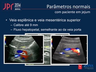 Parâmetros normais
com paciente em jejum
• Veia esplênica e veia mesentérica superior
– Calibre até 9 mm
– Fluxo hepatopetal, semelhante ao da veia porta
 