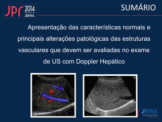 Apresentação das características normais e
principais alterações patológicas das estruturas
vasculares que devem ser avaliadas no exame
de US com Doppler Hepático
SUMÁRIO
 