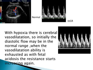 Normal




With hypoxia there is cerebral
vasodilatation, so initially the
diastolic flow may be in the
normal range ,when the
vasodilatation ability is
exhausted as with fetal
acidosis the resistance starts
increasing again.
 