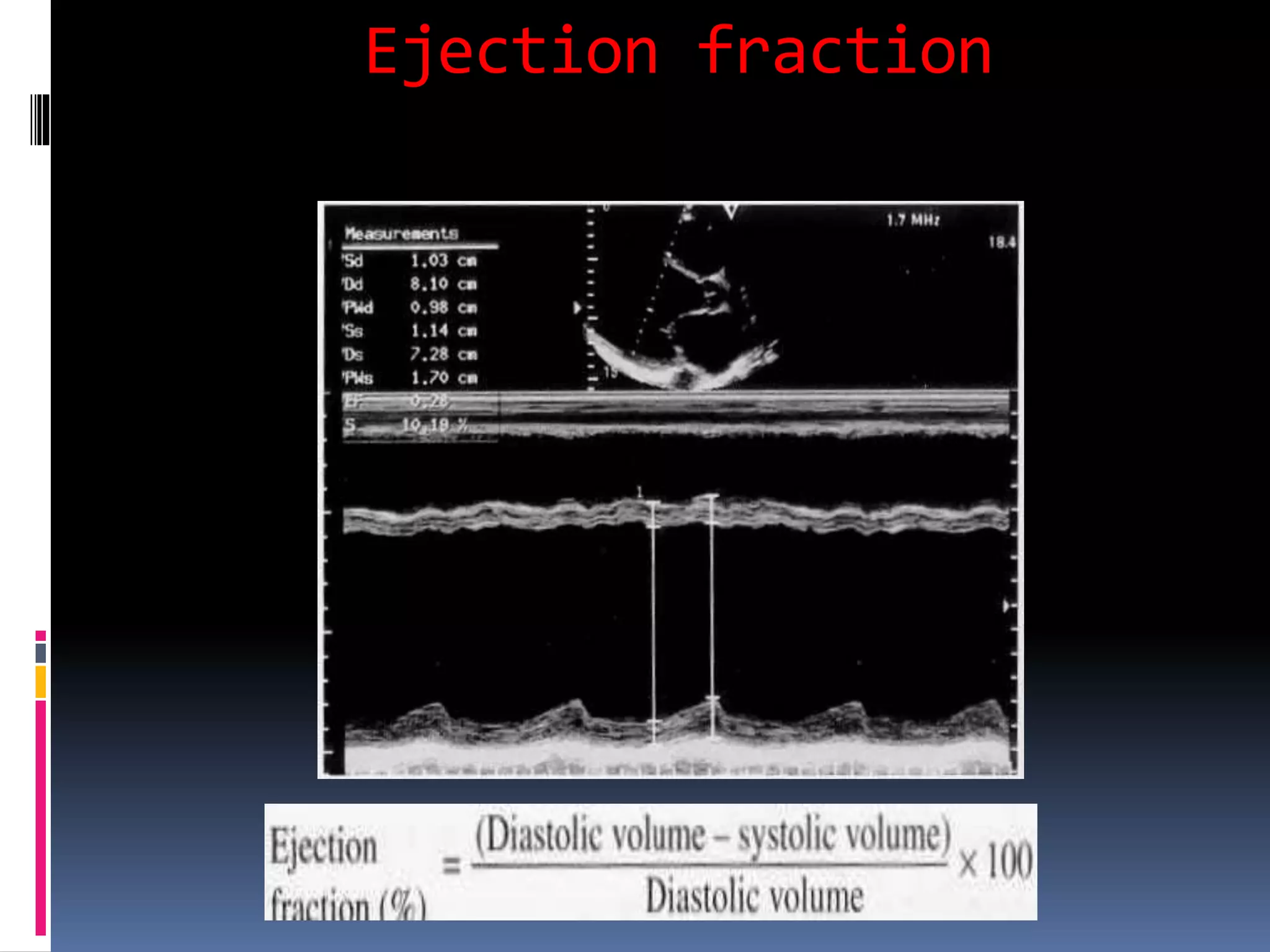 Ejection fraction
 