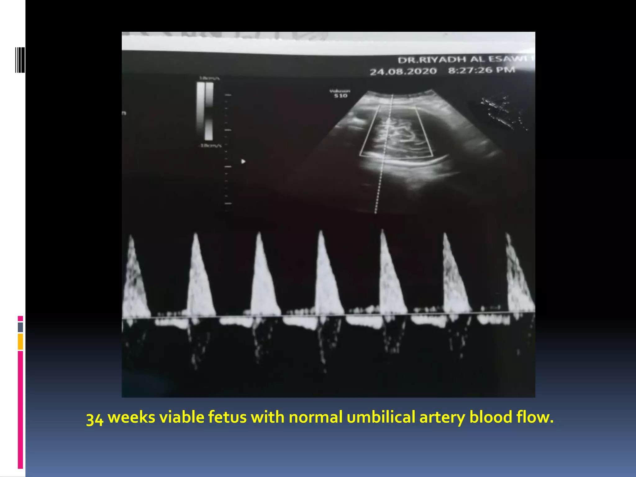 34 weeks viable fetus with normal umbilical artery blood flow.
 