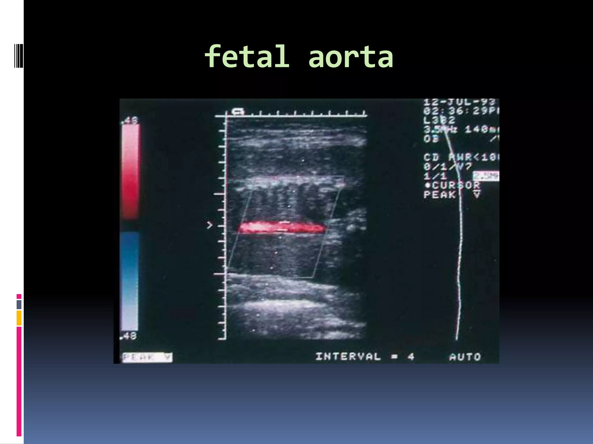 fetal aorta
 