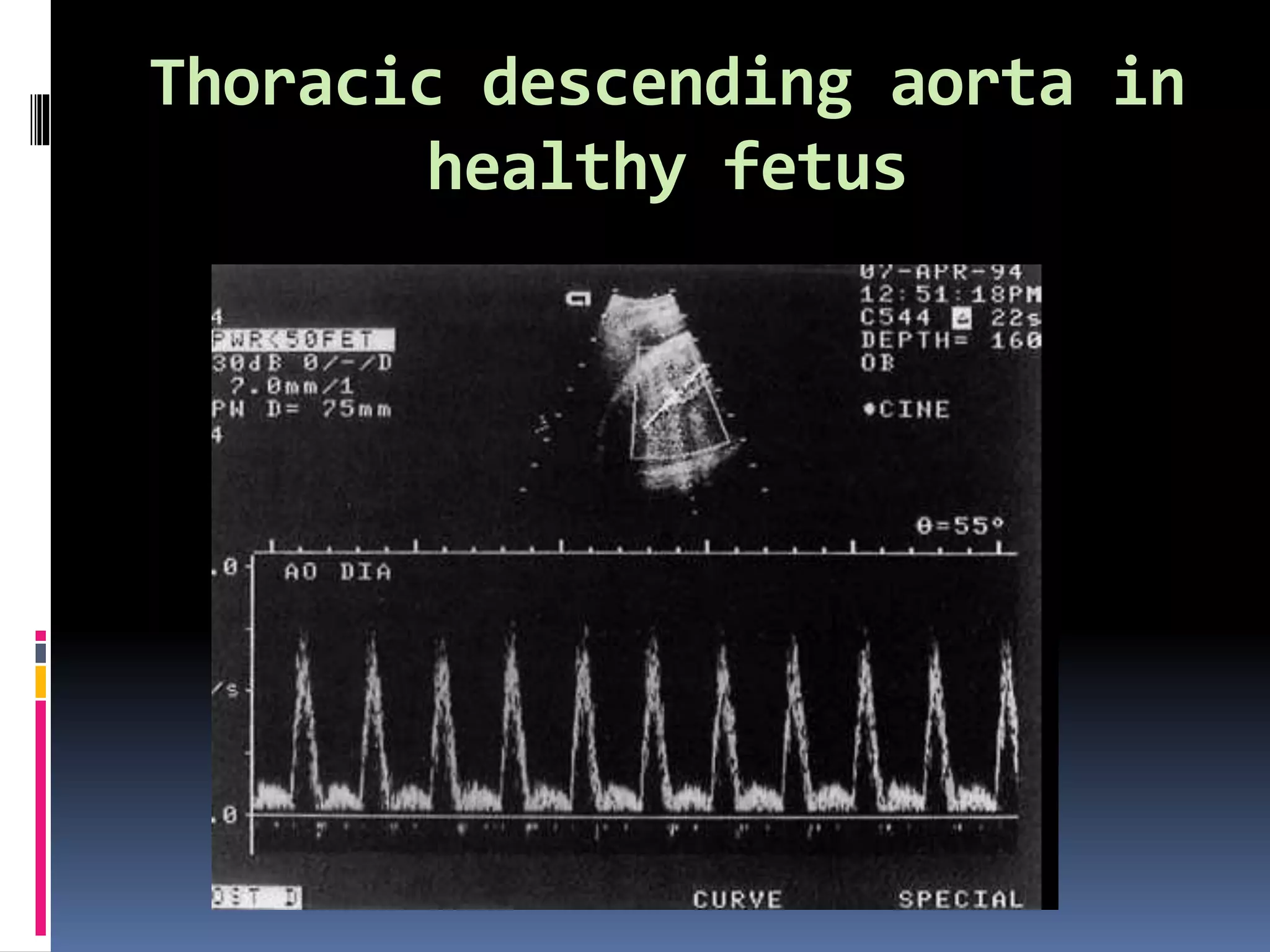 Thoracic descending aorta in
healthy fetus
 