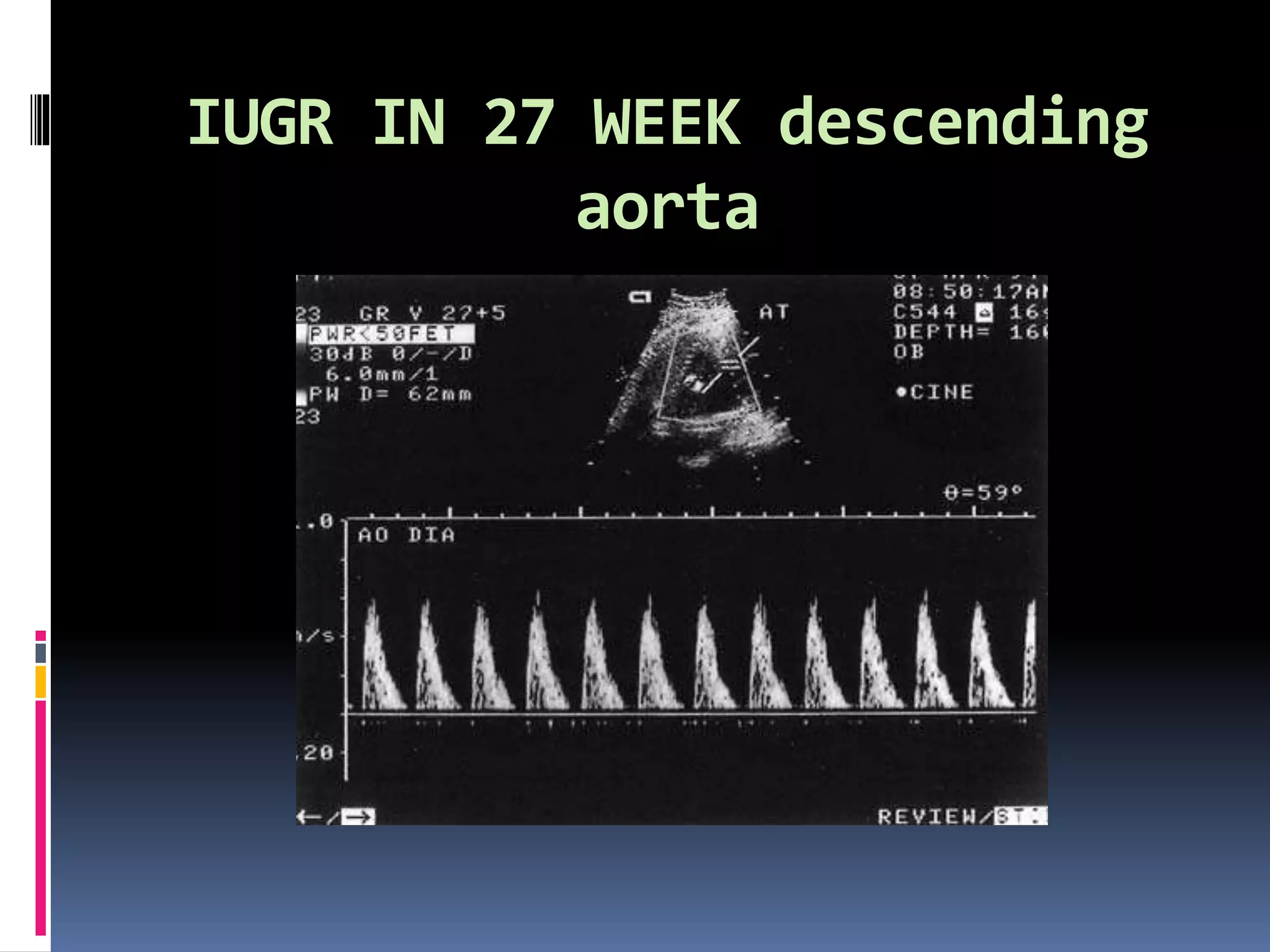 IUGR IN 27 WEEK descending
aorta
 