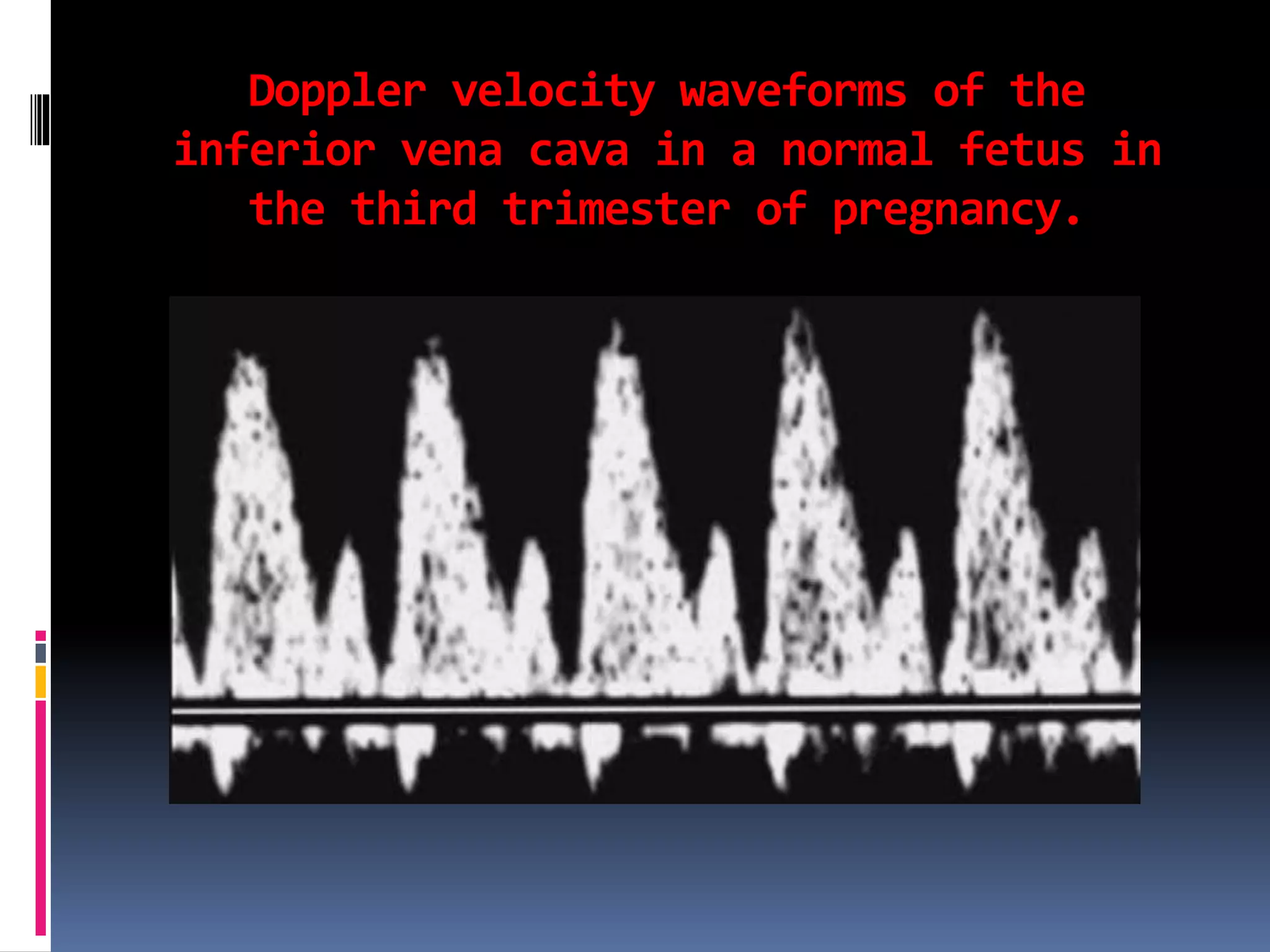 Doppler velocity waveforms of the
inferior vena cava in a normal fetus in
the third trimester of pregnancy.
 