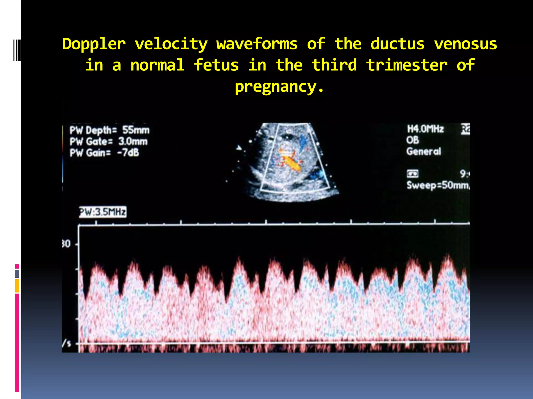 Doppler velocity waveforms of the ductus venosus
in a normal fetus in the third trimester of
pregnancy.
 