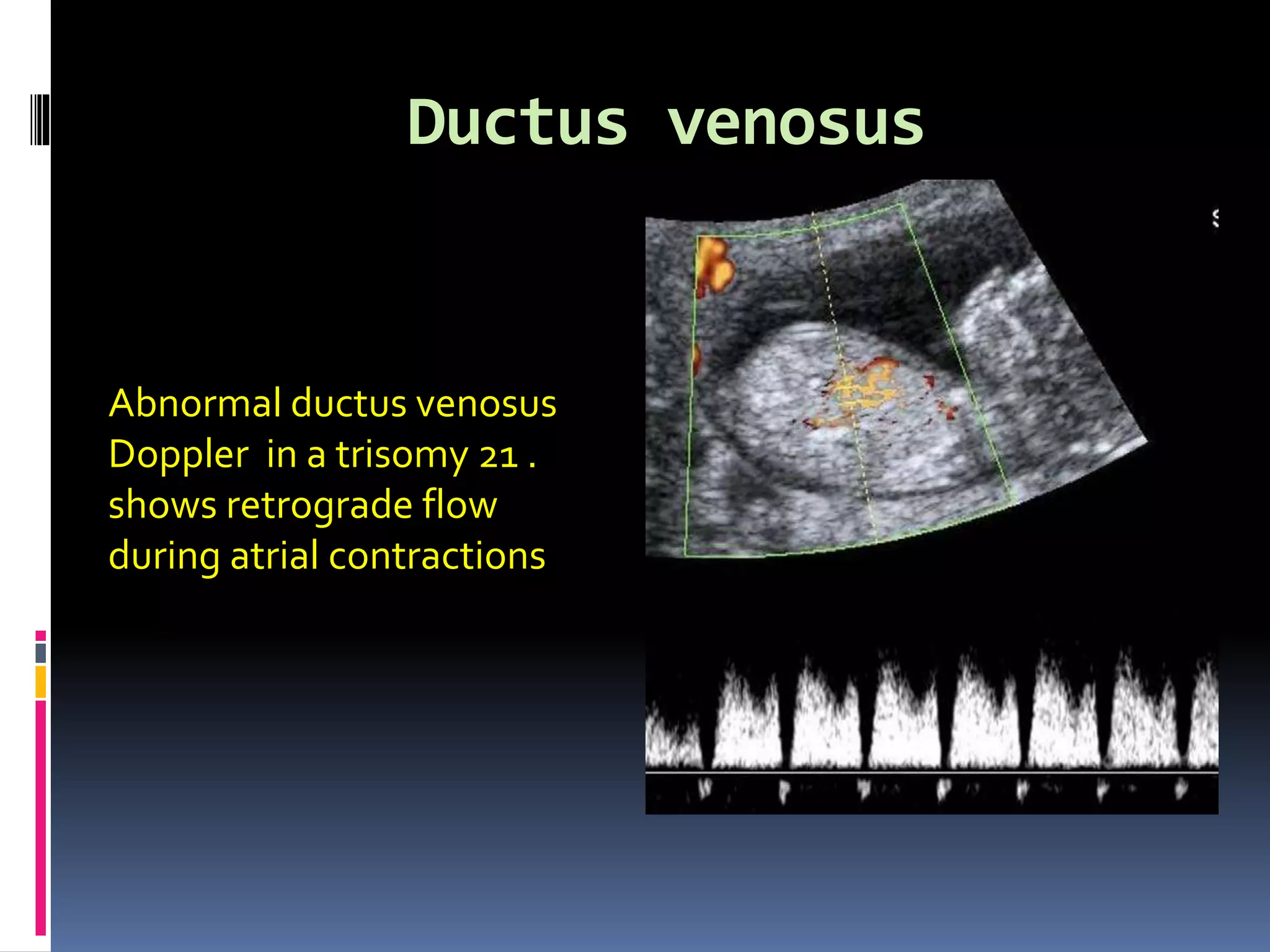 Ductus venosus
Abnormal ductus venosus
Doppler in a trisomy 21 .
shows retrograde flow
during atrial contractions
 