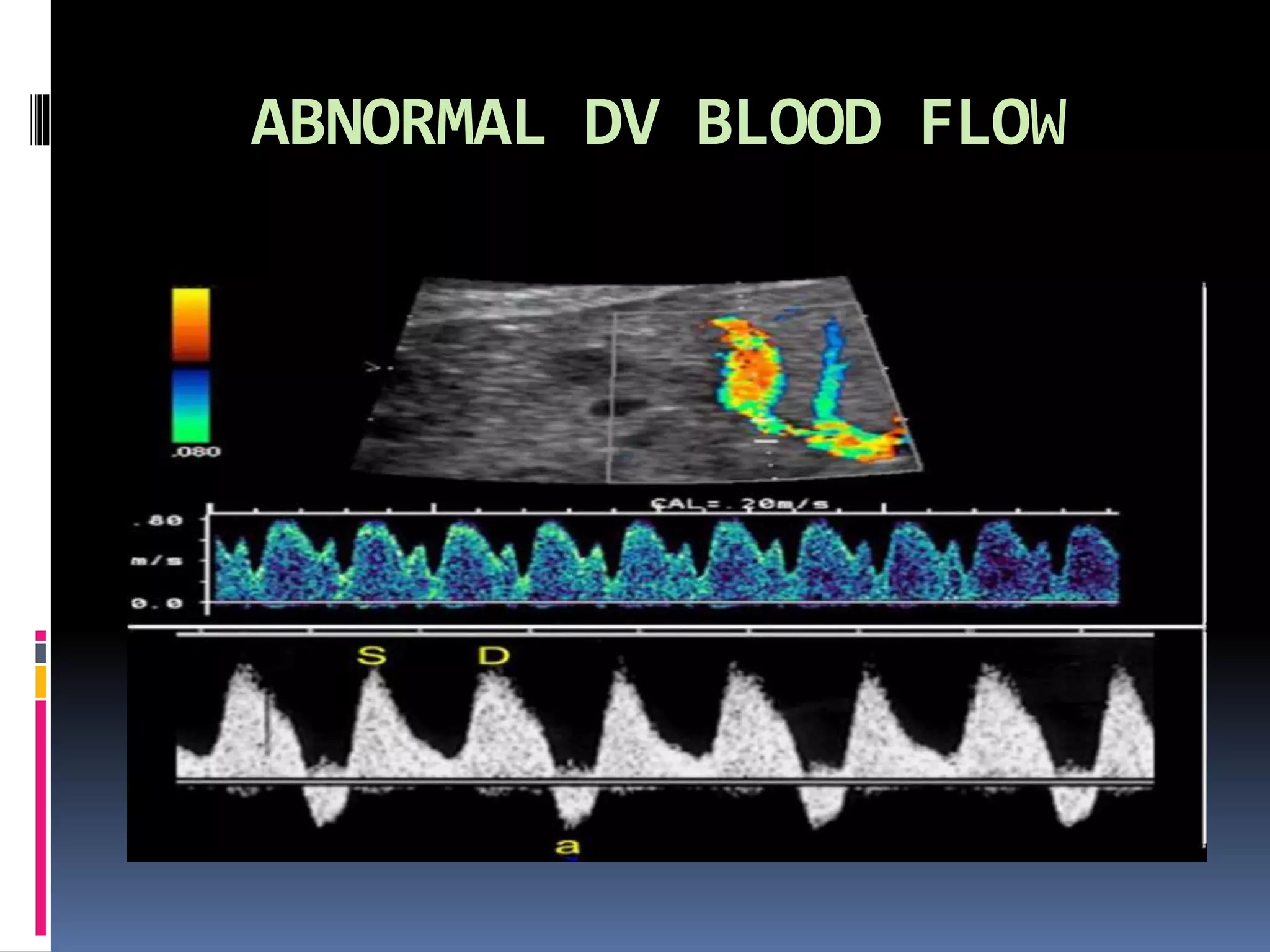 ABNORMAL DV BLOOD FLOW
 