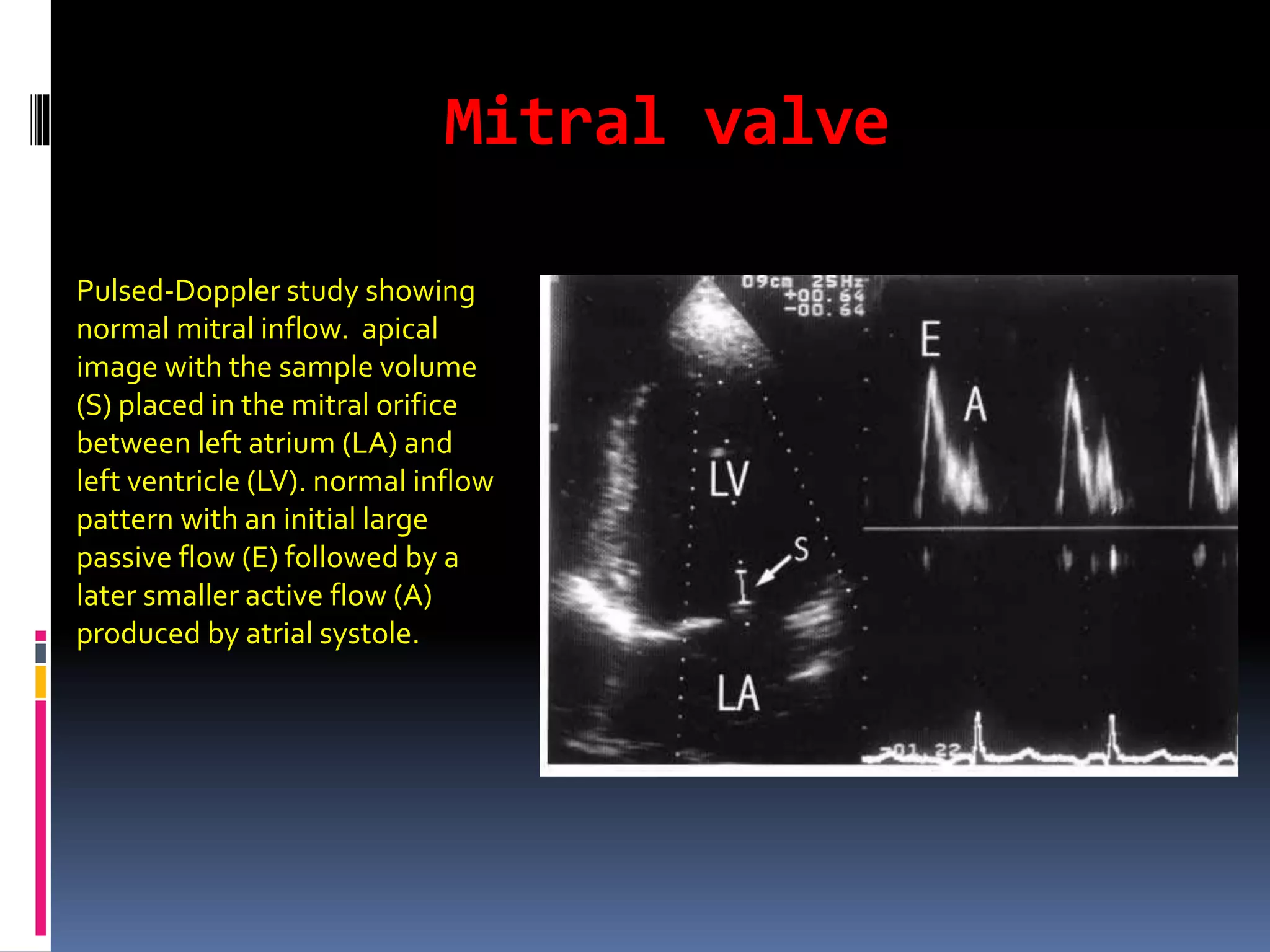 Mitral valve
Pulsed-Doppler study showing
normal mitral inflow. apical
image with the sample volume
(S) placed in the mitral orifice
between left atrium (LA) and
left ventricle (LV). normal inflow
pattern with an initial large
passive flow (E) followed by a
later smaller active flow (A)
produced by atrial systole.
 