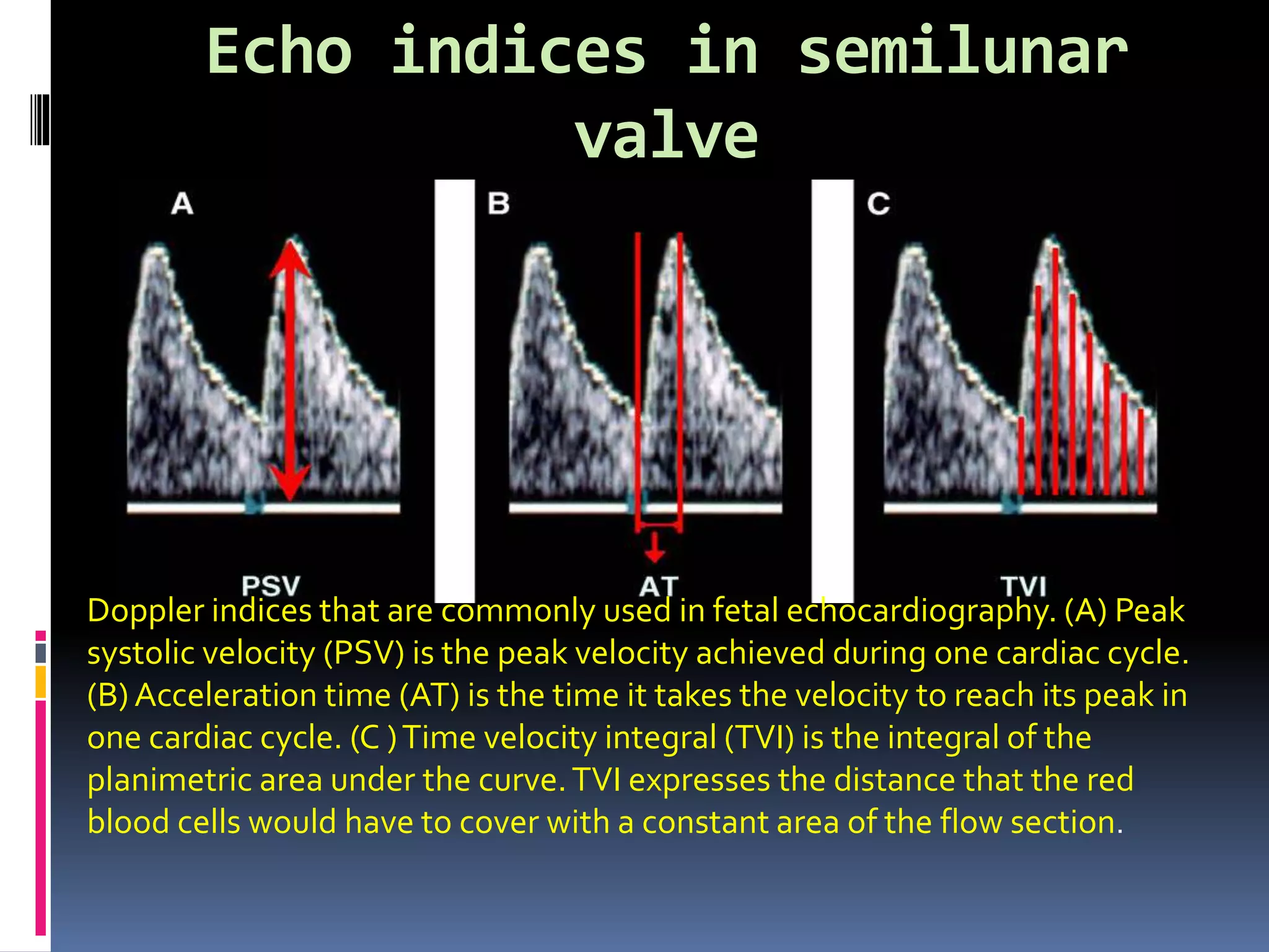 Echo indices in semilunar
valve
Doppler indices that are commonly used in fetal echocardiography. (A) Peak
systolic velocity (PSV) is the peak velocity achieved during one cardiac cycle.
(B) Acceleration time (AT) is the time it takes the velocity to reach its peak in
one cardiac cycle. (C )Time velocity integral (TVI) is the integral of the
planimetric area under the curve.TVI expresses the distance that the red
blood cells would have to cover with a constant area of the flow section.
 