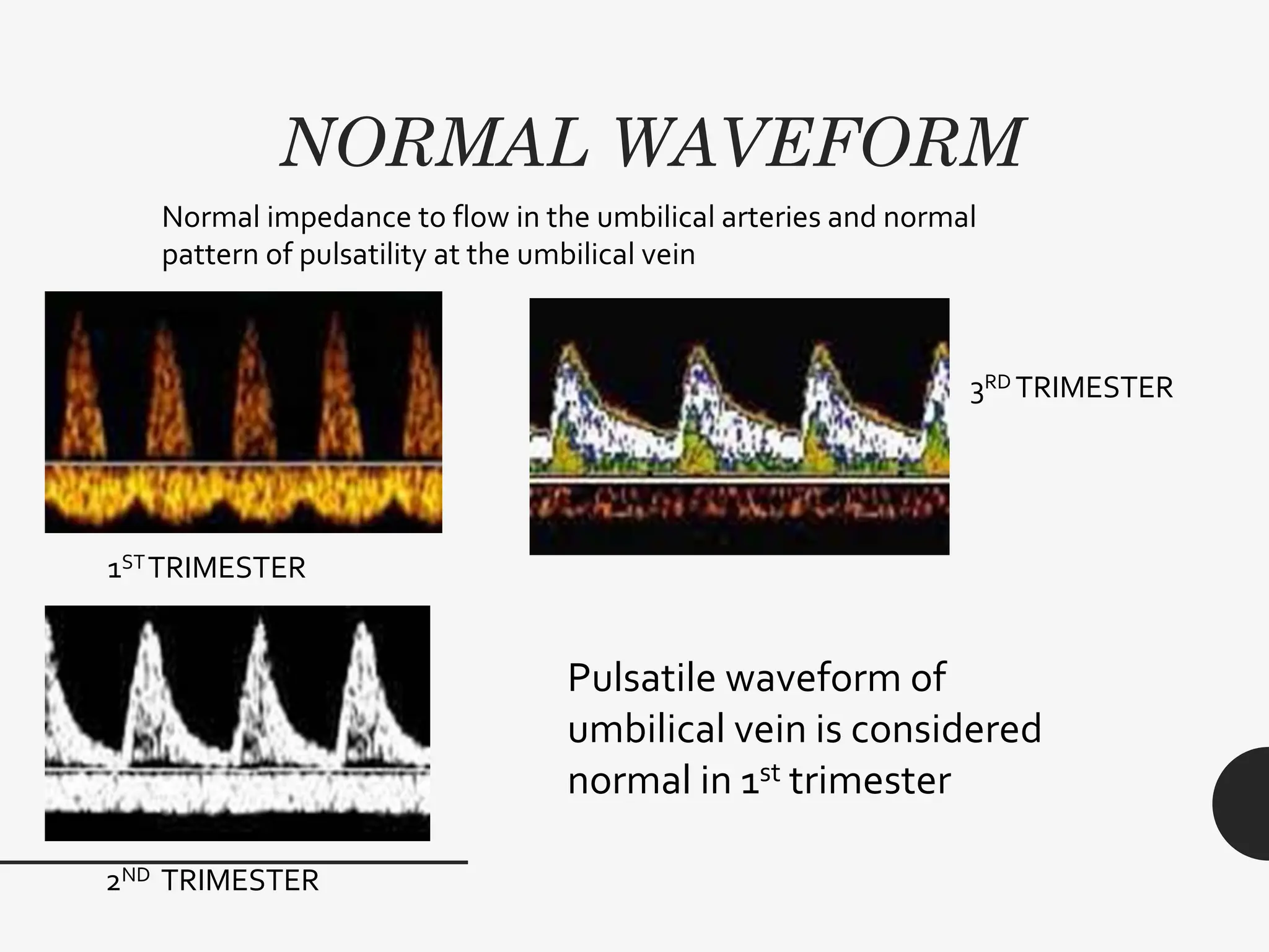 NORMAL WAVEFORM
Normal impedance to flow in the umbilical arteries and normal
pattern of pulsatility at the umbilical vein
1STTRIMESTER
2ND TRIMESTER
3RD TRIMESTER
Pulsatile waveform of
umbilical vein is considered
normal in 1st trimester
 