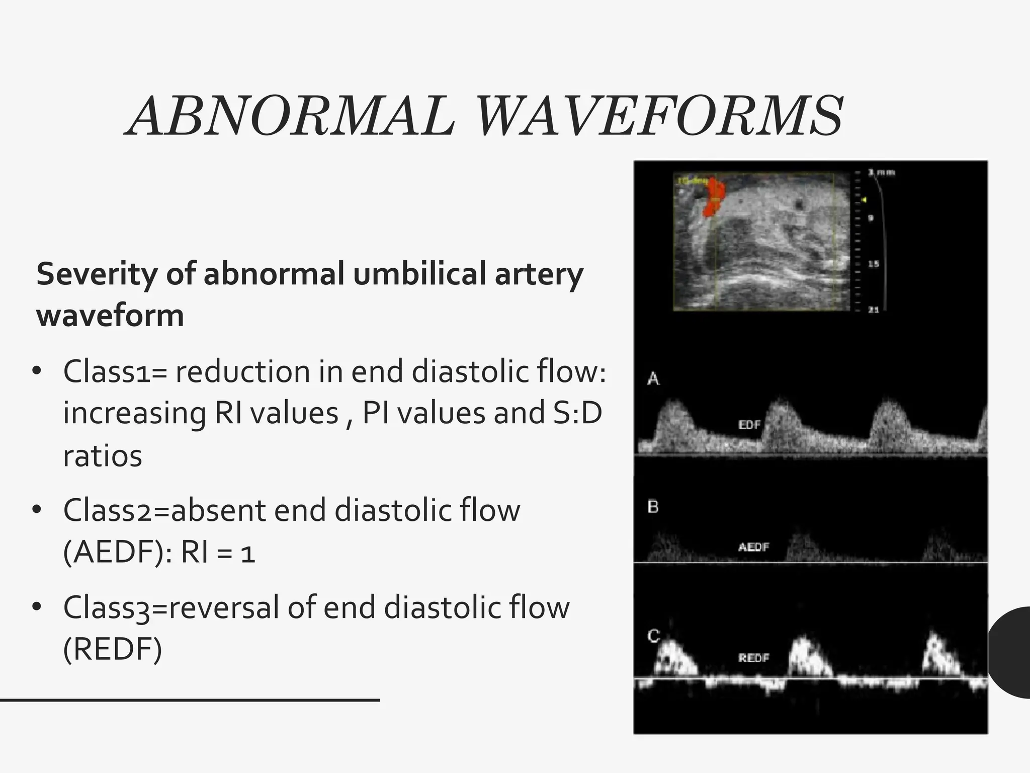 ABNORMAL WAVEFORMS
Severity of abnormal umbilical artery
waveform
• Class1= reduction in end diastolic flow:
increasing RI values , PI values and S:D
ratios
• Class2=absent end diastolic flow
(AEDF): RI = 1
• Class3=reversal of end diastolic flow
(REDF)
 