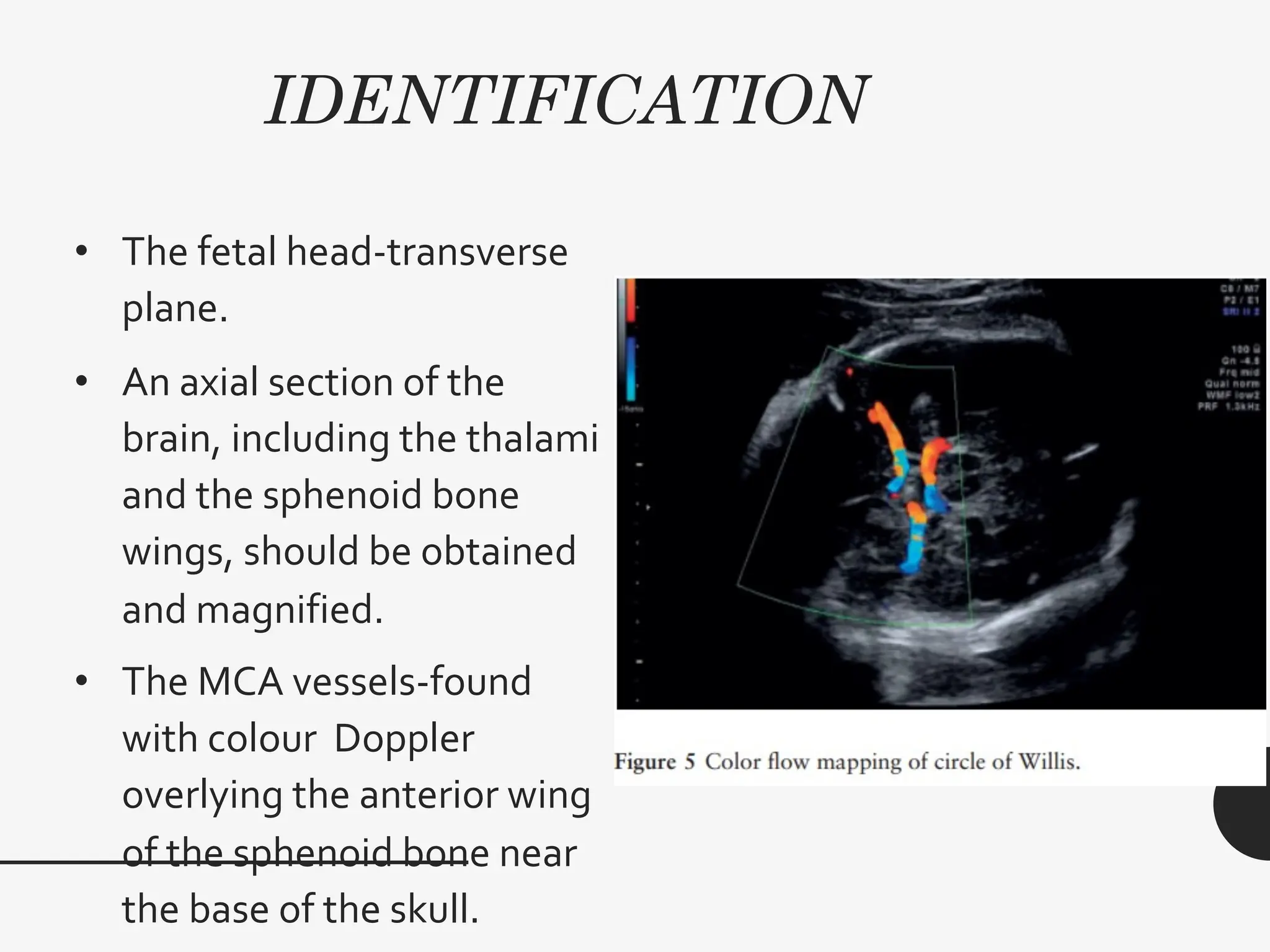IDENTIFICATION
• The fetal head-transverse
plane.
• An axial section of the
brain, including the thalami
and the sphenoid bone
wings, should be obtained
and magnified.
• The MCA vessels-found
with colour Doppler
overlying the anterior wing
of the sphenoid bone near
the base of the skull.
 