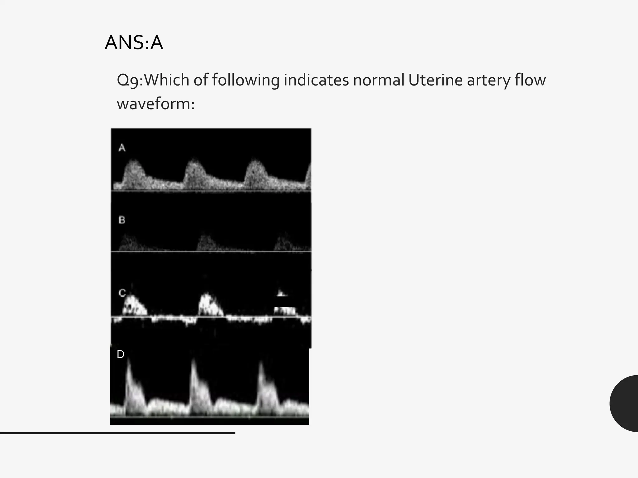 Q9:Which of following indicates normal Uterine artery flow
waveform:
ANS:A
D
 