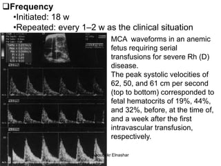 Frequency
•Initiated: 18 w
•Repeated: every 1–2 w as the clinical situation
MCA waveforms in an anemic
fetus requiring serial
transfusions for severe Rh (D)
disease.
The peak systolic velocities of
62, 50, and 61 cm per second
(top to bottom) corresponded to
fetal hematocrits of 19%, 44%,
and 32%, before, at the time of,
and a week after the first
intravascular transfusion,
respectively.
Aboubakr Elnashar
 