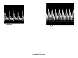 IUGR
Normal
Aboubakr Elnashar
 