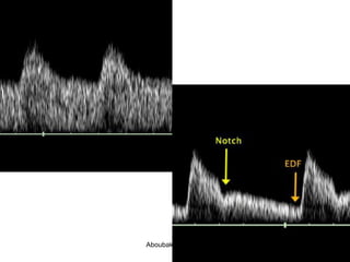 UAD: Normal
UAD: notch,
decreased diastolic
flow
Aboubakr Elnashar
 