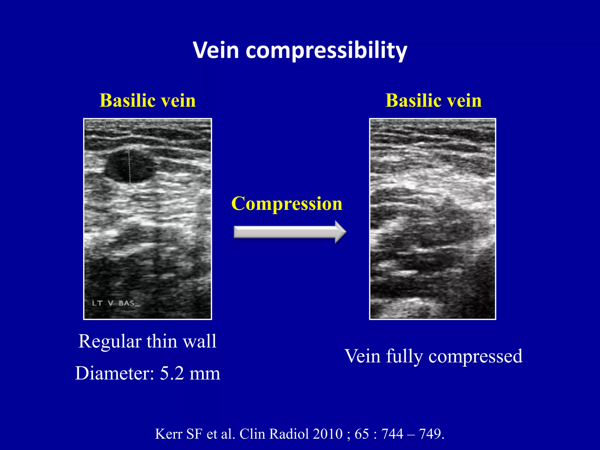 Doppler ultrasound of A-V access for hemodialysis | PPTX