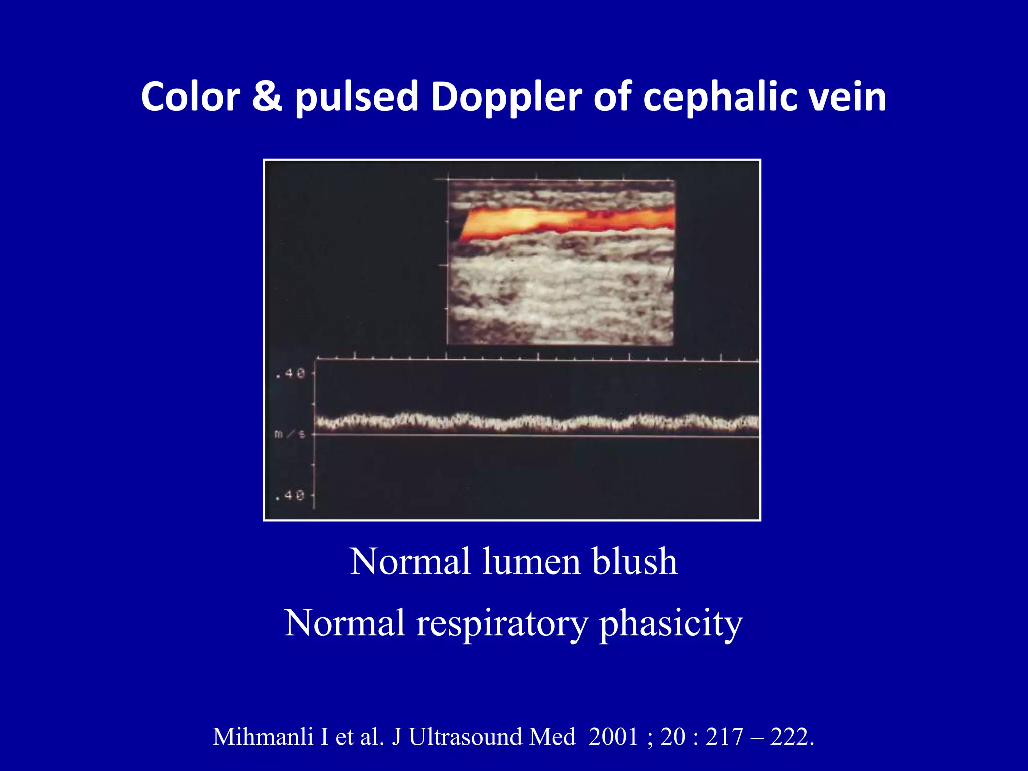 Doppler ultrasound of A-V access for hemodialysis | PPTX