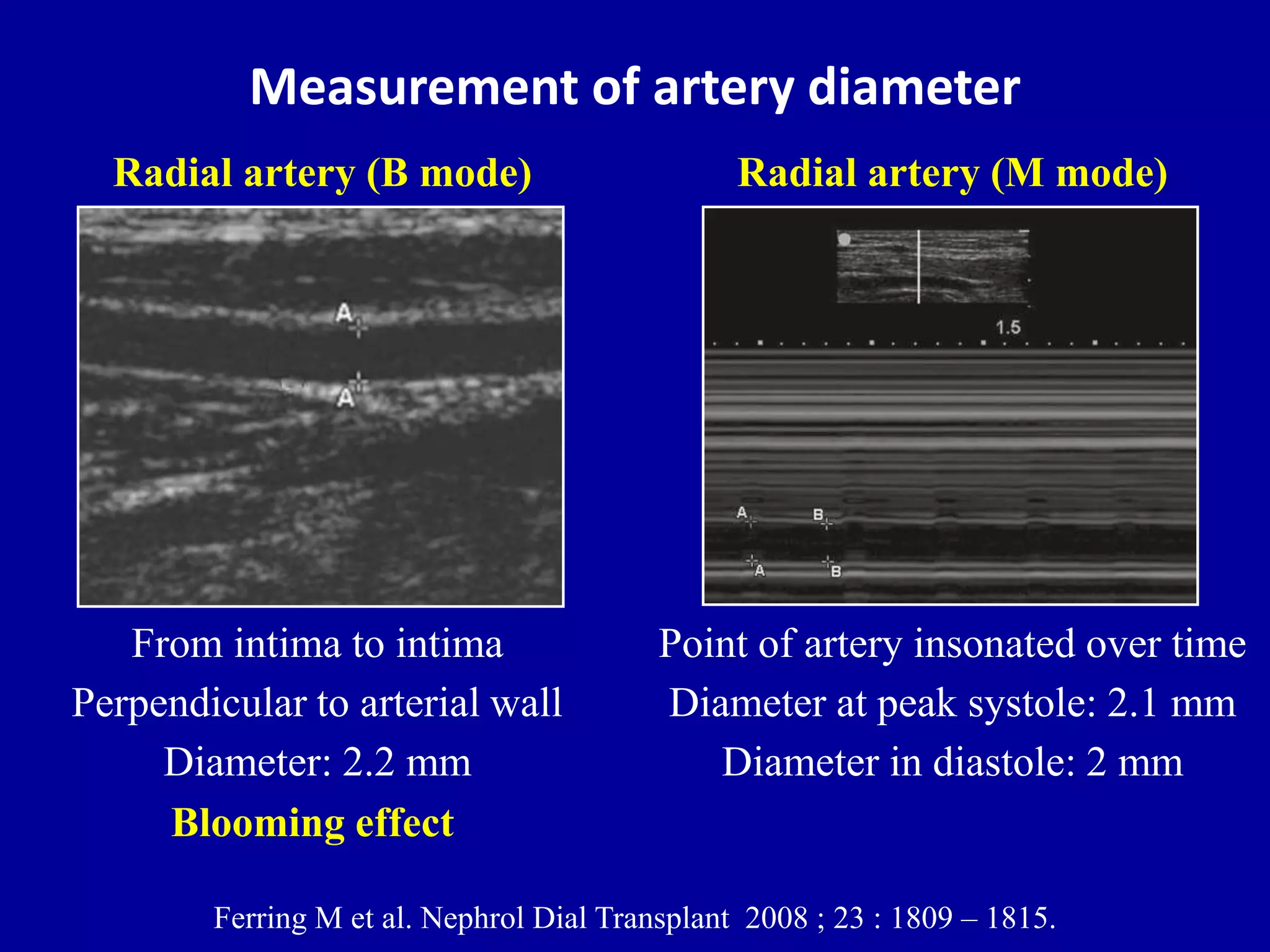Doppler ultrasound of A-V access for hemodialysis | PPTX