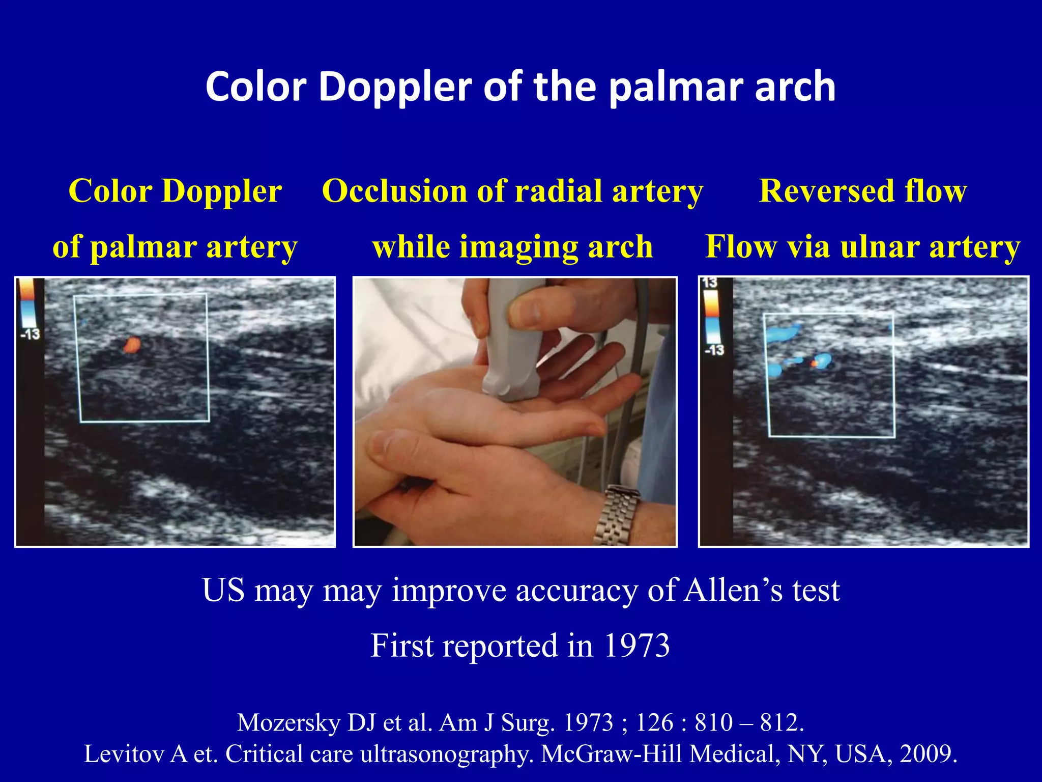 Doppler ultrasound of A-V access for hemodialysis | PPTX