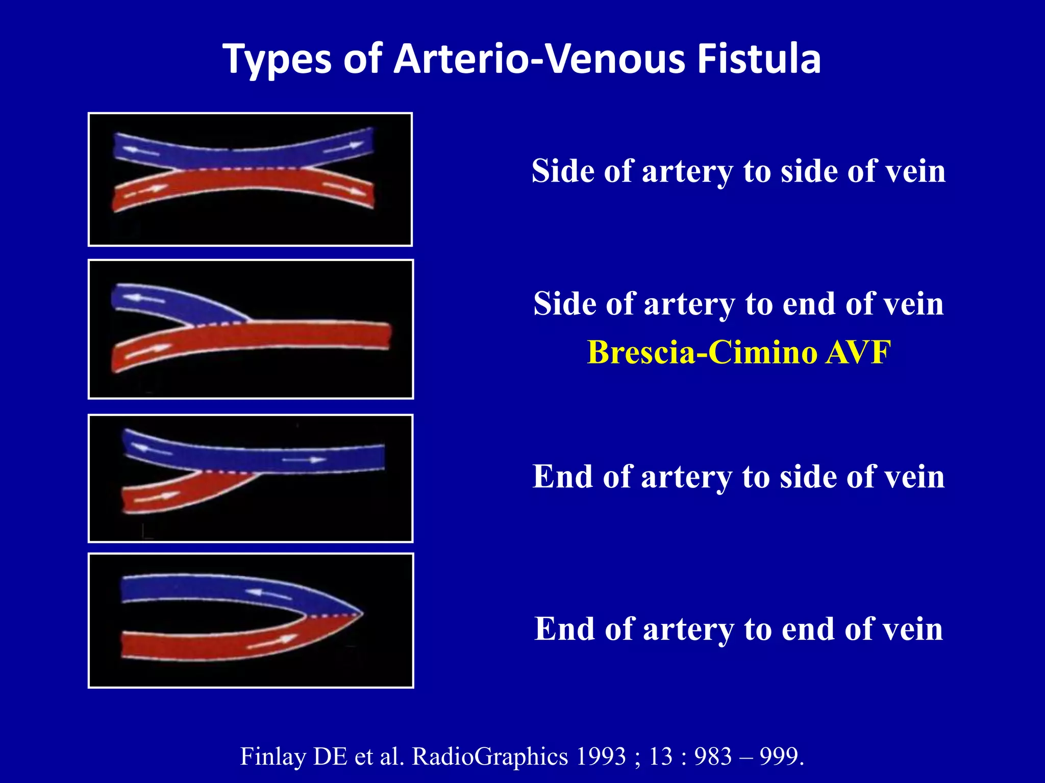 Doppler ultrasound of A-V access for hemodialysis | PPTX