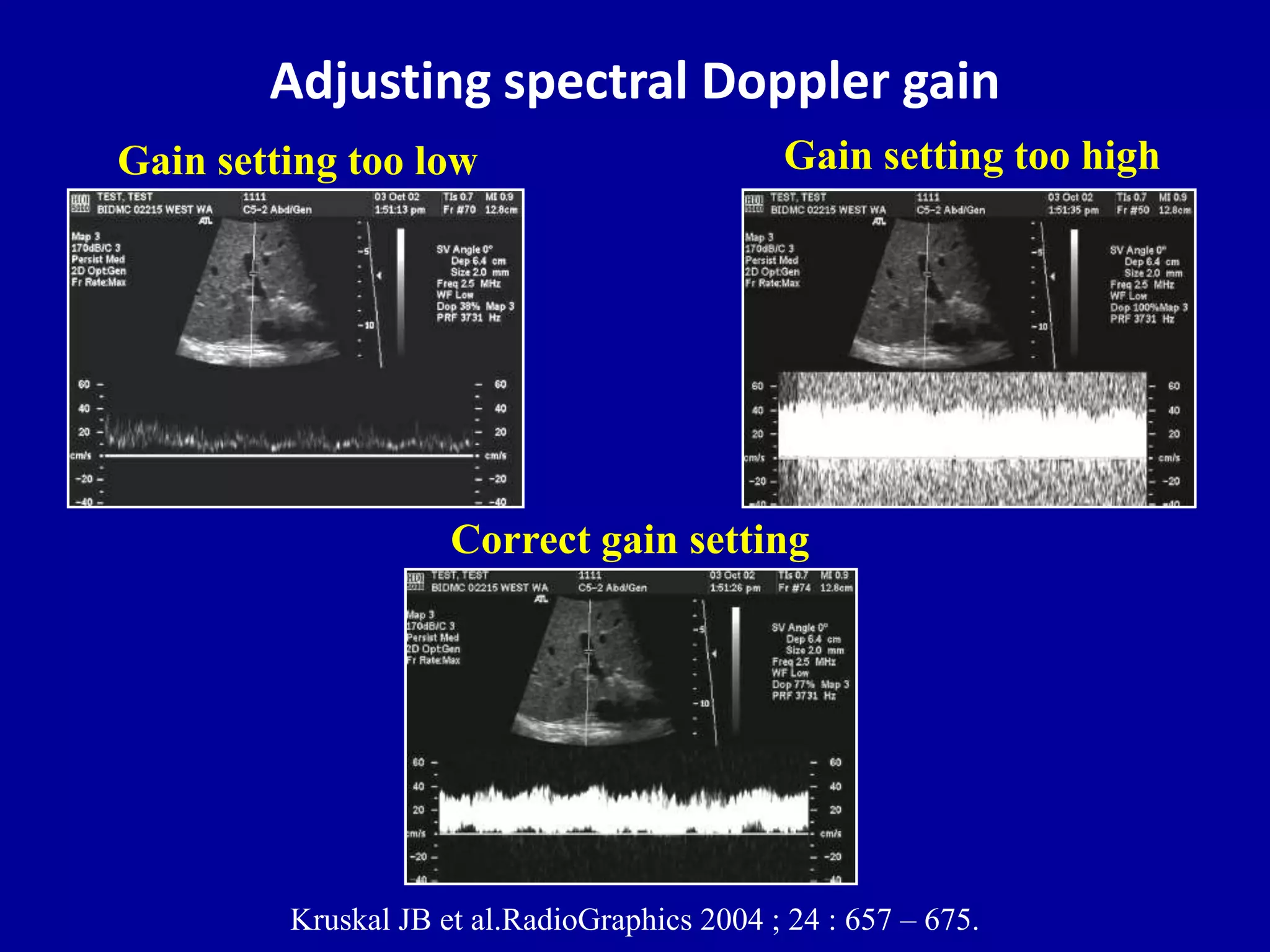 Doppler ultrasound of A-V access for hemodialysis | PPTX