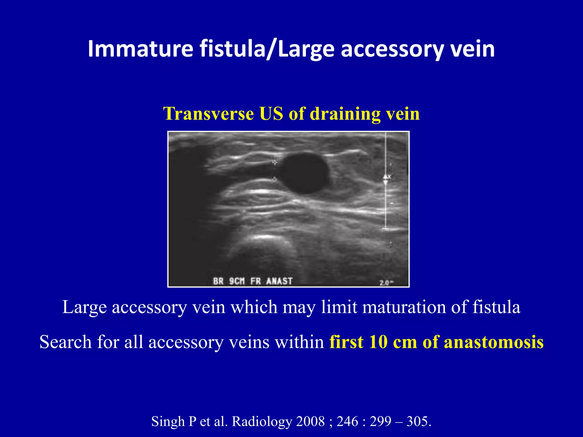 Doppler ultrasound of A-V access for hemodialysis | PPTX
