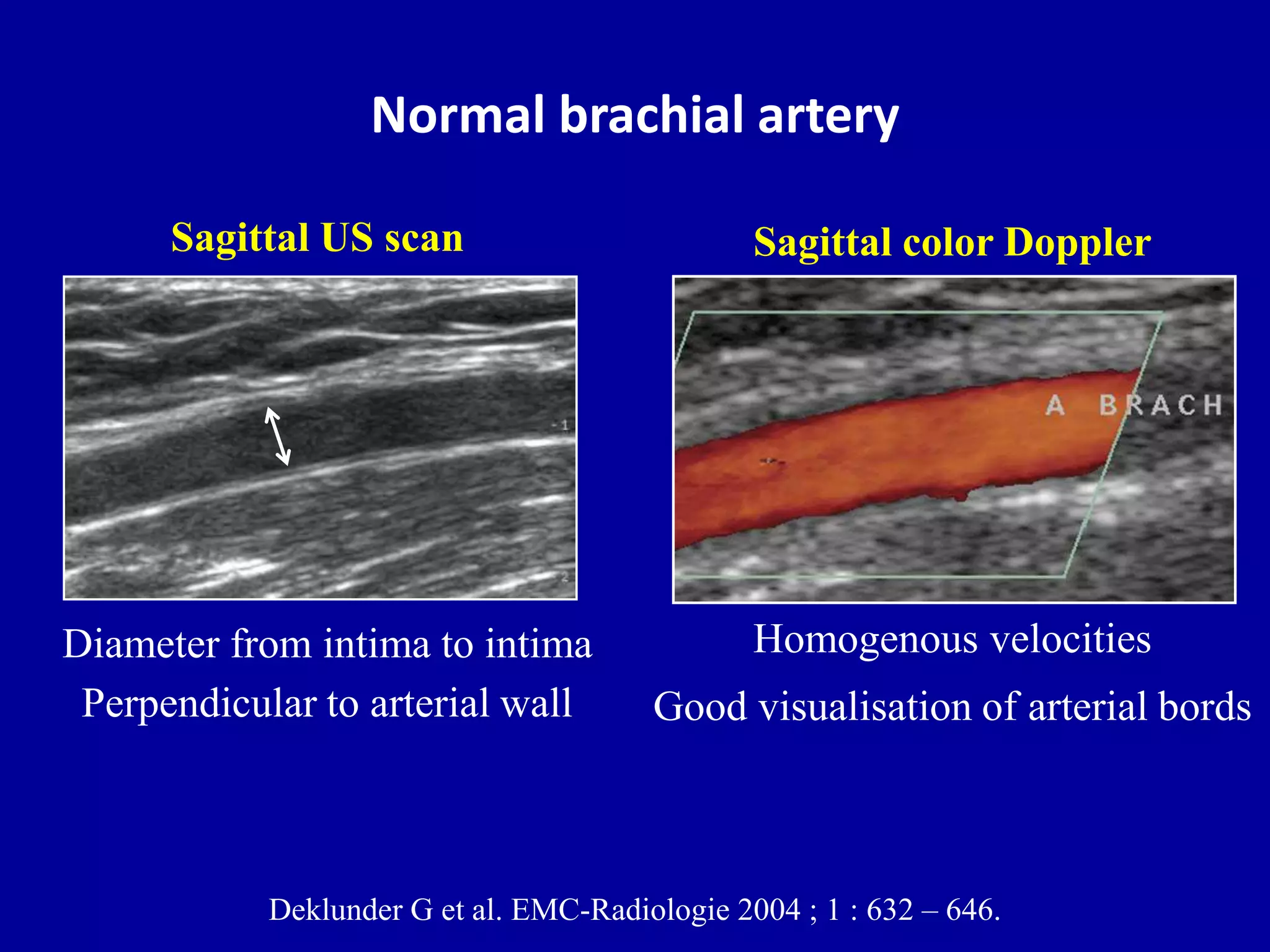 Doppler ultrasound of A-V access for hemodialysis | PPTX