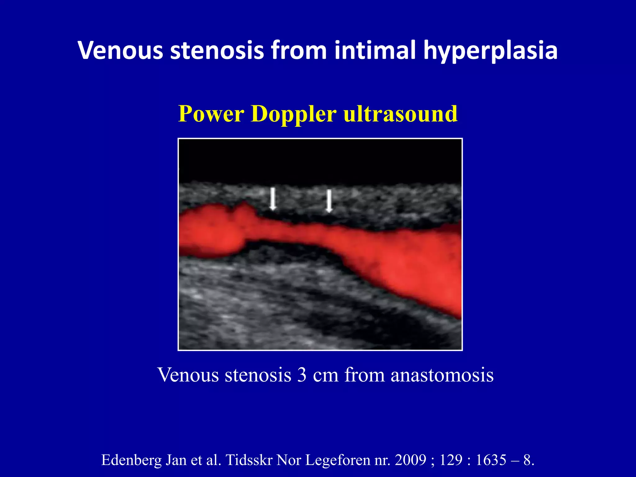 Doppler ultrasound of A-V access for hemodialysis | PPTX