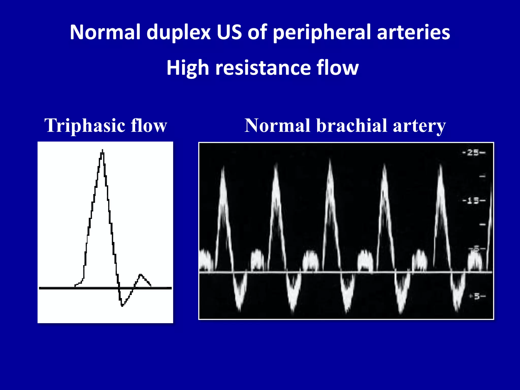Doppler ultrasound of A-V access for hemodialysis | PPTX