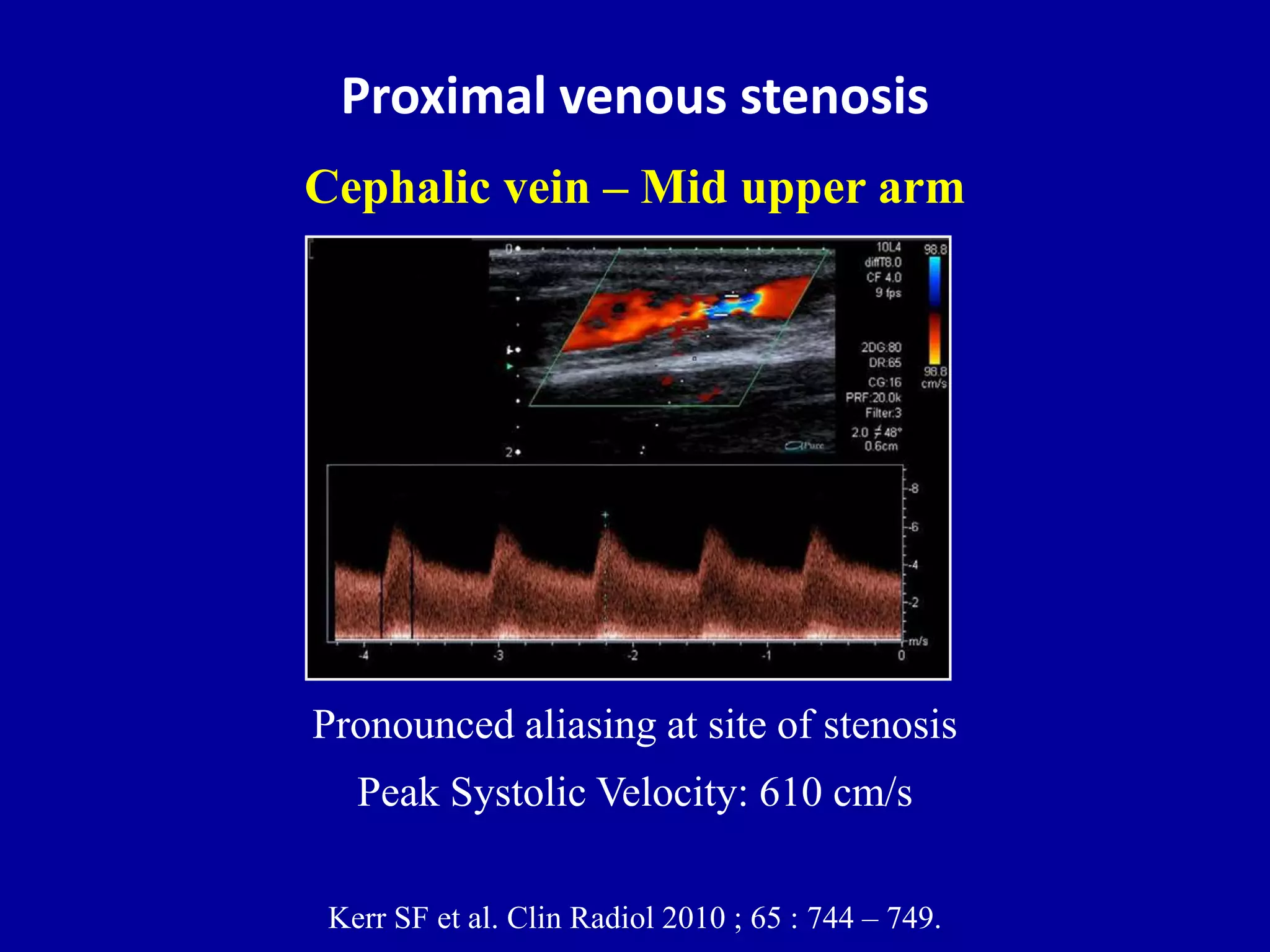 Doppler ultrasound of A-V access for hemodialysis | PPTX