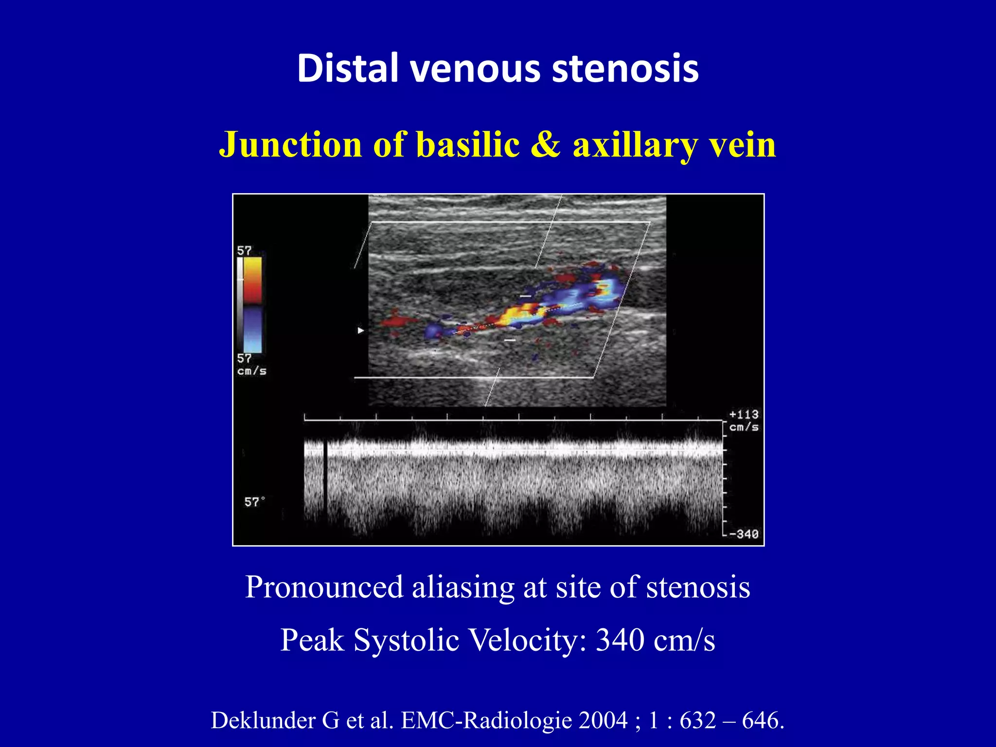 Doppler ultrasound of A-V access for hemodialysis | PPTX