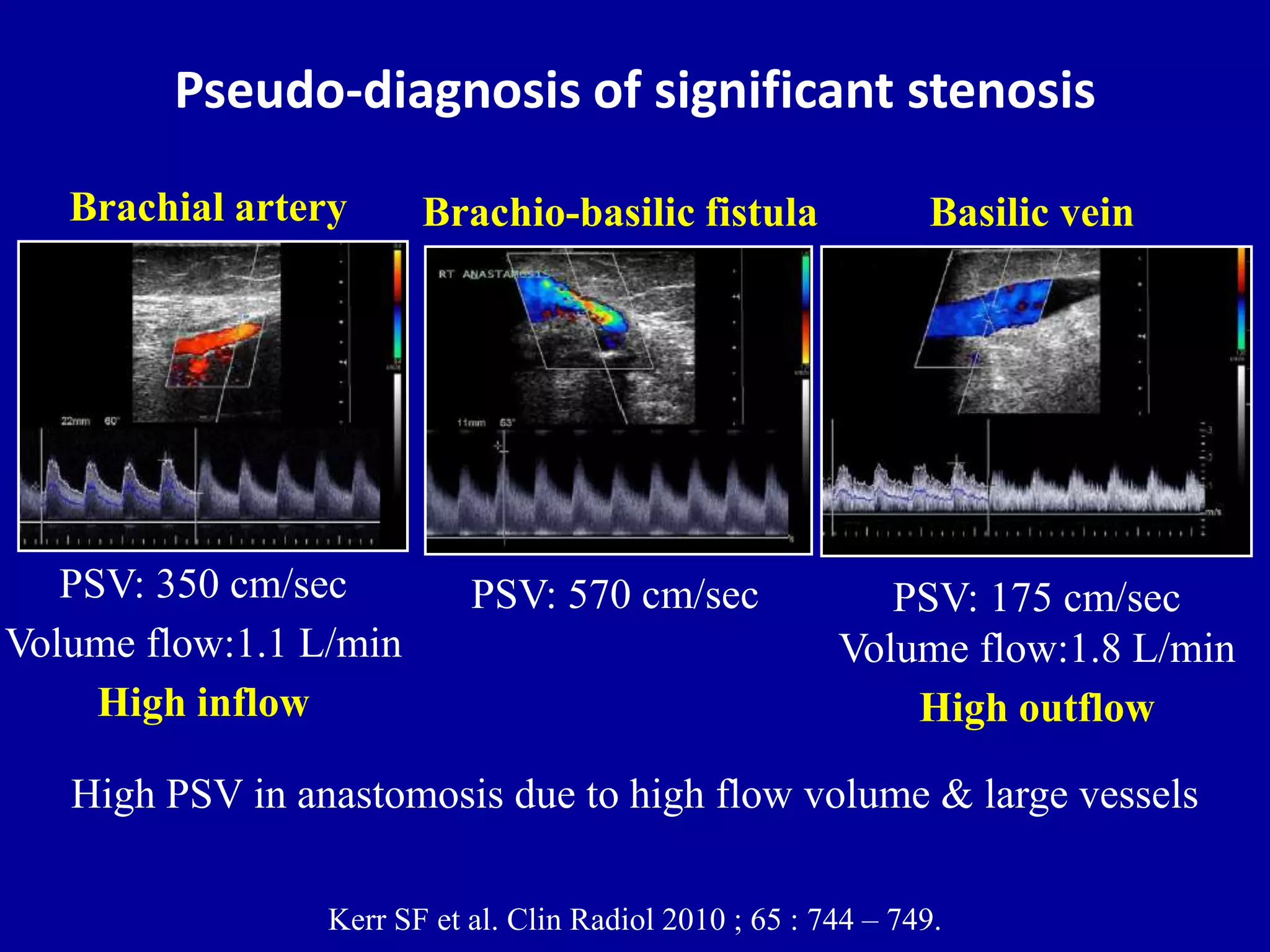 Doppler ultrasound of A-V access for hemodialysis | PPTX