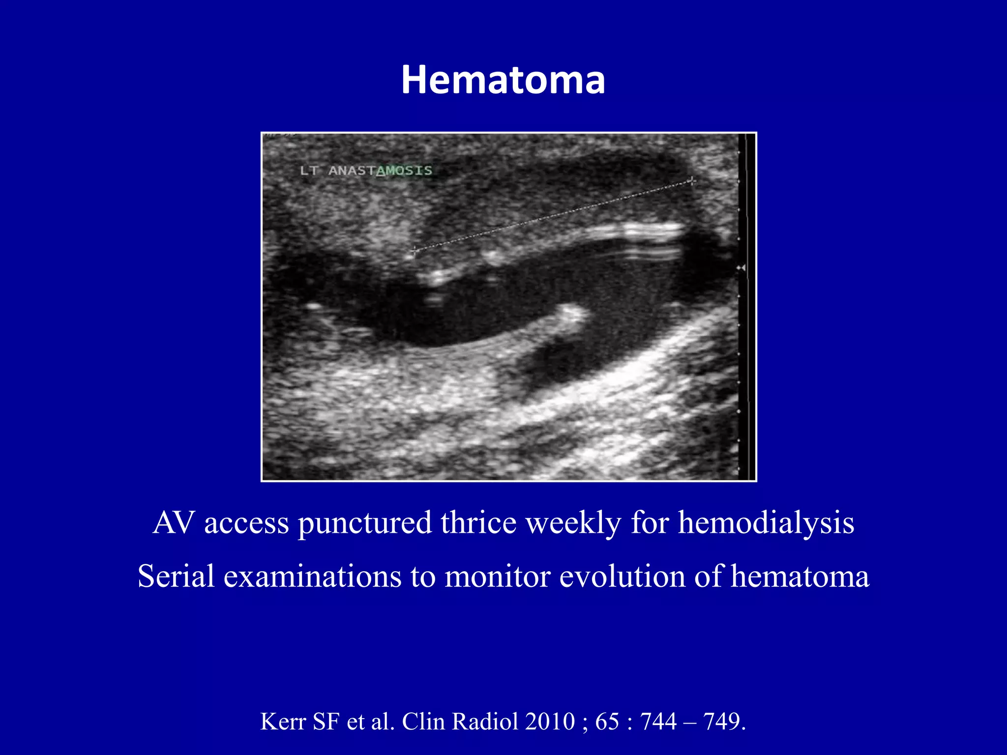 Doppler ultrasound of A-V access for hemodialysis | PPTX